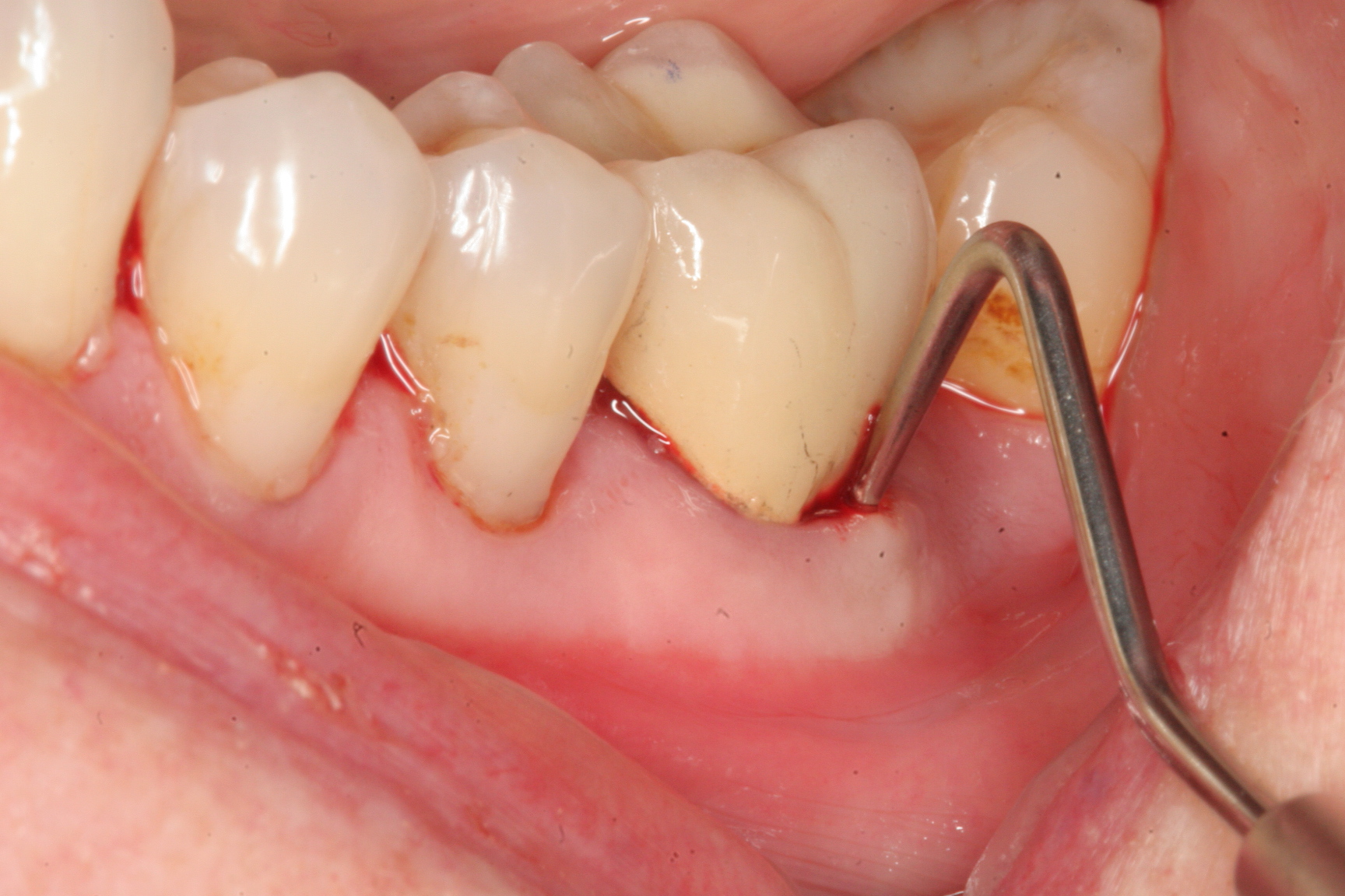 Abscessed Teeth Perio Peak
